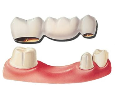 Diagram of a dental bridge with replacement tooth in the center and anchor teeth below it tapered for crowns