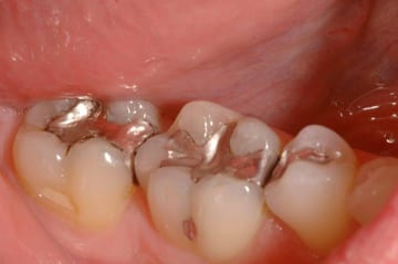 Mercury-free dentistry before photo of three lower molars with amalgam fillings
