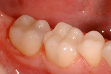 Mercury-free dentistry after photo of three lower molars with new composite fillings