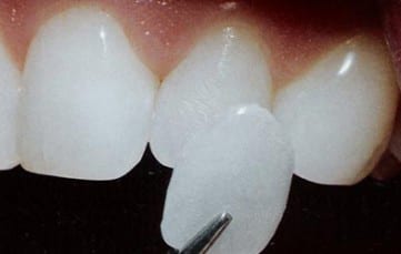 A single porcelain veneer, held next to a lateral incisor
