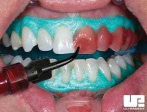 Retracted cheeks with Opalescence Boost being applied to teeth instead of Zoom whitening