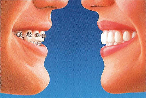 Side by Side of Invisalign compared to traditional braces