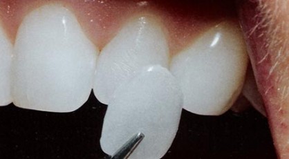 One porcelain veener held next to a tooth, for information on the Lumineers brand.