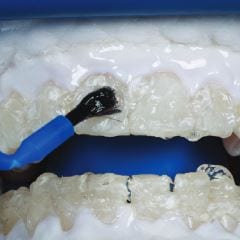 Zoom bleaching gel being applied to a patient's teeth