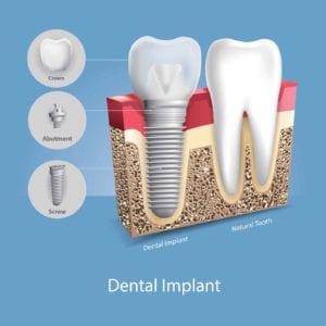 illustration of a dental implant next to a natural tooth
