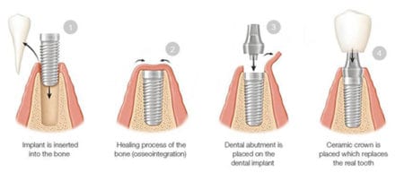 illustration of the dental implant process