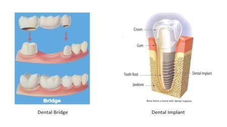 Dental Bridge and Dental implant 