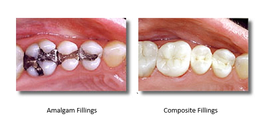before and after silver fillings