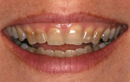 an image of teeth with tetracycline stains