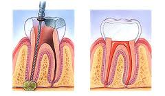 Example of a root canal treatment