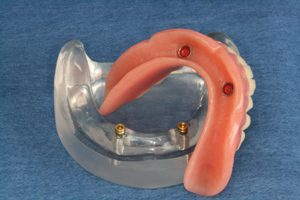 Image of a snap on denture