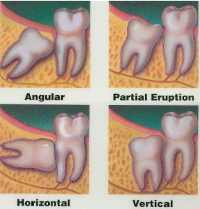 Illustration of impacted wisdom teeth
