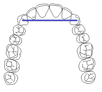 Example of a cantilever bridge diagram