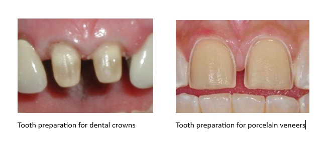 Tooth preparation comparison