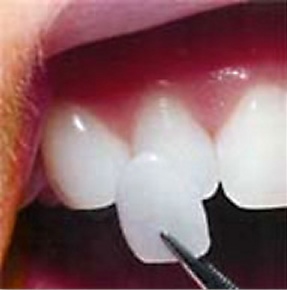 porcelain veneer being placed on teeth