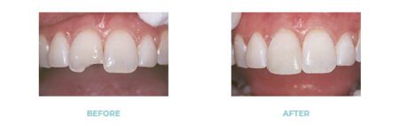 An image showing before and after dental bonding.