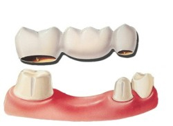An illustration of a dental bridge.