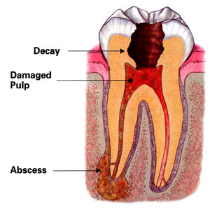 Illustration of an abscessed tooth