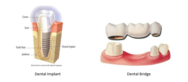 A dental implant image next to one of a dental bridge