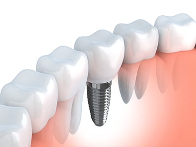 An illustration of a dental implant between teeth