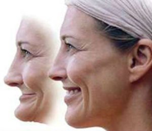 an image showing the results of facial collapse. A shrunken jaw.